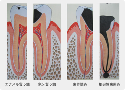 三宅歯科医院のむし歯治療