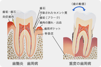 歯周病治療